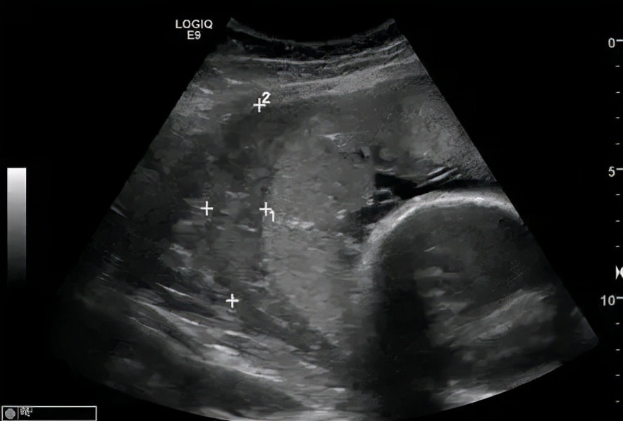 孕妇胎盘早剥抢救,胎盘早剥抢救预案