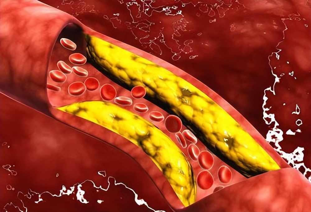 吃深海鱼油对血管狭窄有帮助吗,醋红酒鱼油是否能软化血管