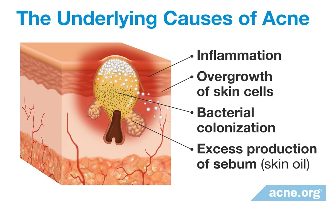 博乐达超分子水杨酸保湿霜,博乐达水杨酸洗面奶油皮痘肌