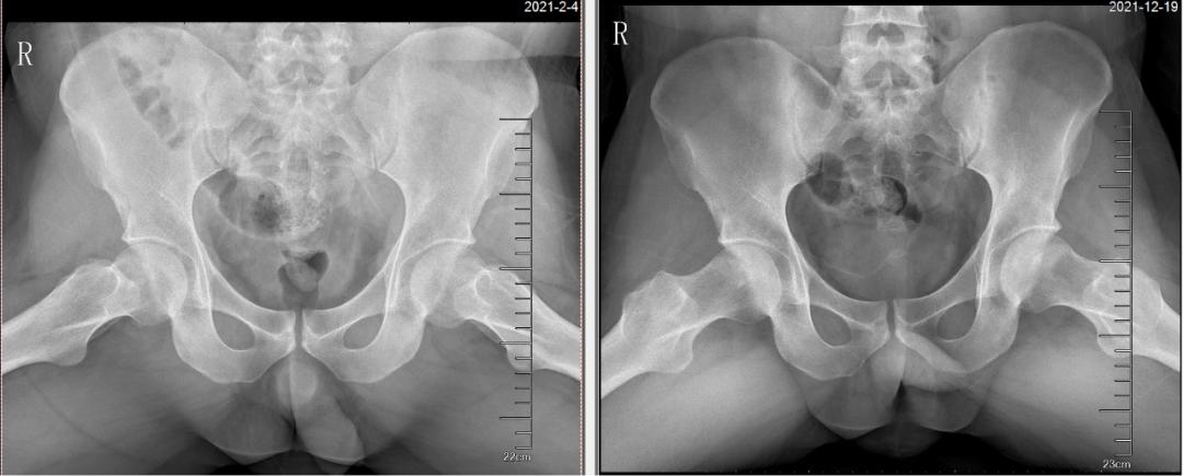 用激素引起股骨头坏死怎么办,因激素药引发的股骨头症状