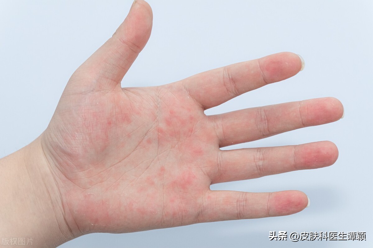 名医讲解汗疱疹的起因和治疗视频,皮肤科汗疱疹