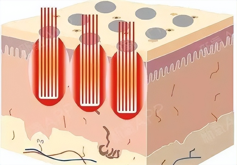 连明星都逃脱不了的高发际线时尚,雄秃现状