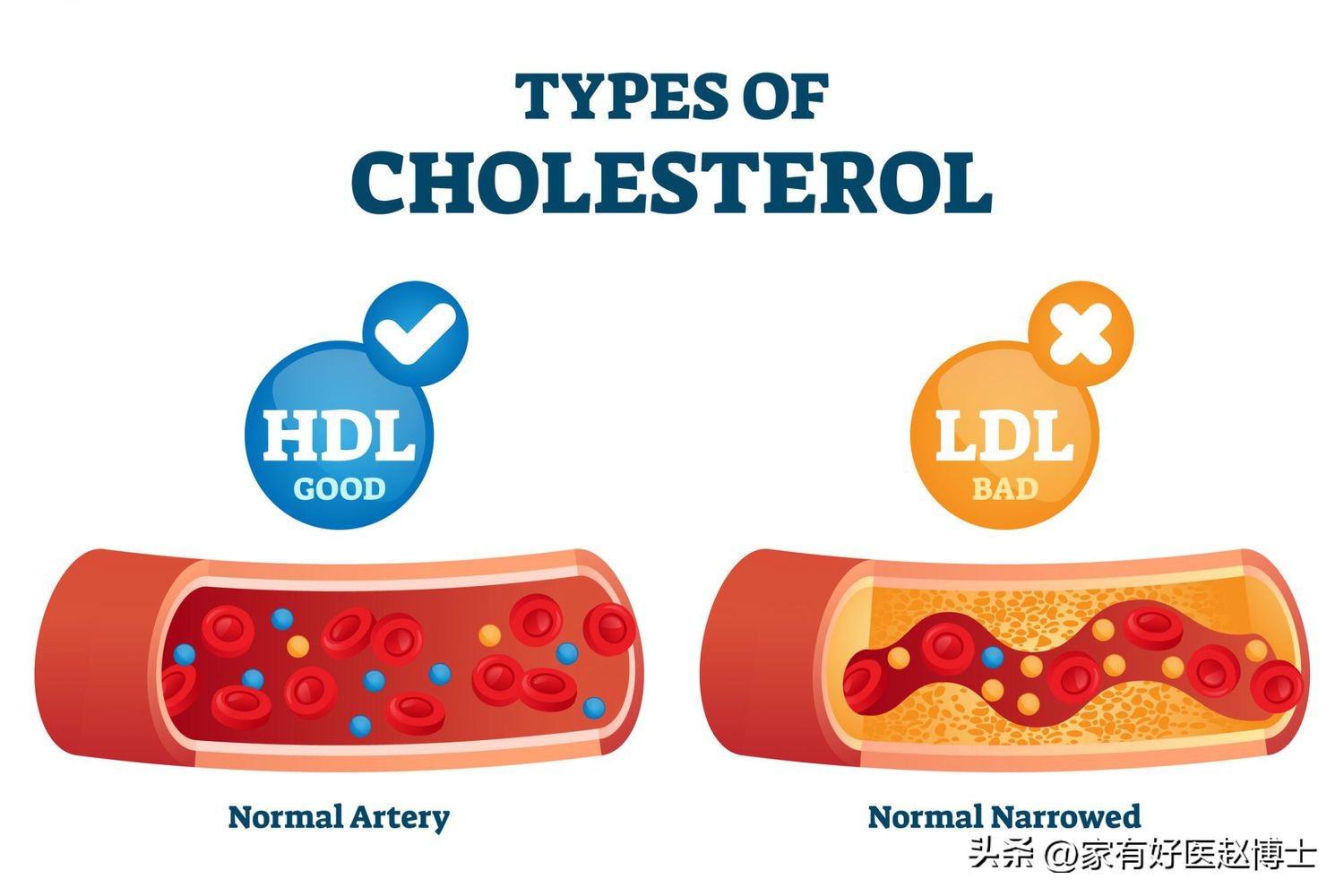 “好胆固醇HDL-C”偏低,用不用吃药提升?最新血脂指南告诉您!