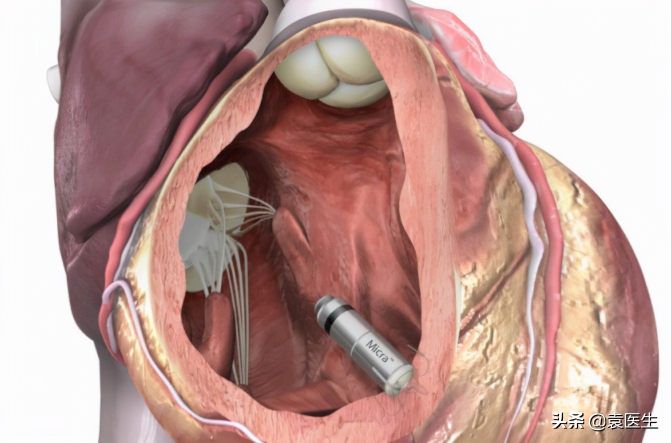 心脏起搏器安装以后心跳还会慢吗,心脏跳得有点快需做什么微创手术