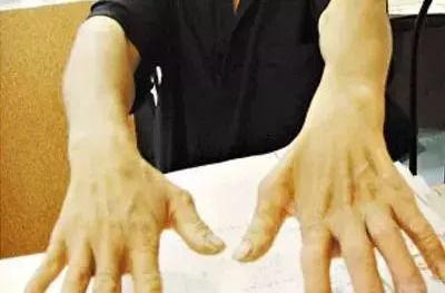 手萎缩无力是什么病,手腕无力手指笨拙虎口萎缩