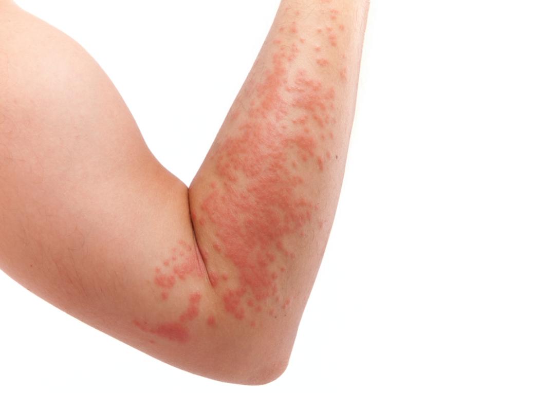 过敏反反复复吃药也没用怎么办,过敏体质反反复复的过敏该怎么办