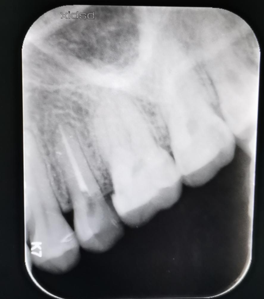 蛀牙已发展成牙髓炎,该如何治疗?