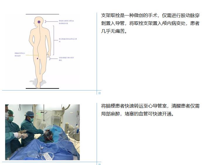 脑梗患者舌底取栓,脑梗取栓是最佳治疗方法吗