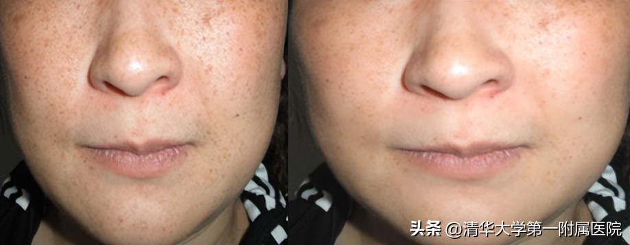 来深度了解皮秒激光美白祛斑效果,皮秒激光美白嫩肤祛斑紧肤