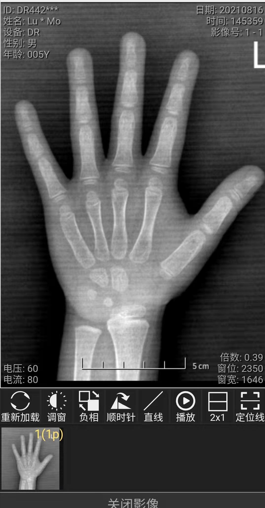 拍骨龄片的正确姿势,如何通过骨龄片看骨龄