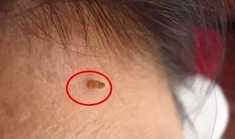 脖子腋下长小肉粒什么原因引起的,脖子上和腋下长小肉粒是什么原因