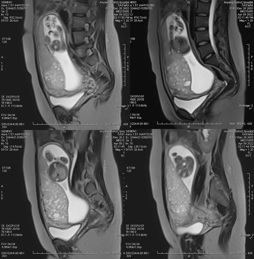 这么典型的葡萄胎MRI影像，快来学习吧