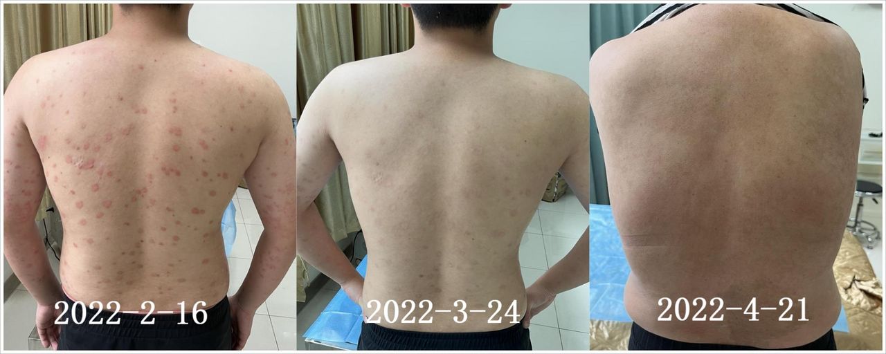 银屑病用生物制剂为什么要查乙肝,小三阳能打银屑病生物制剂吗