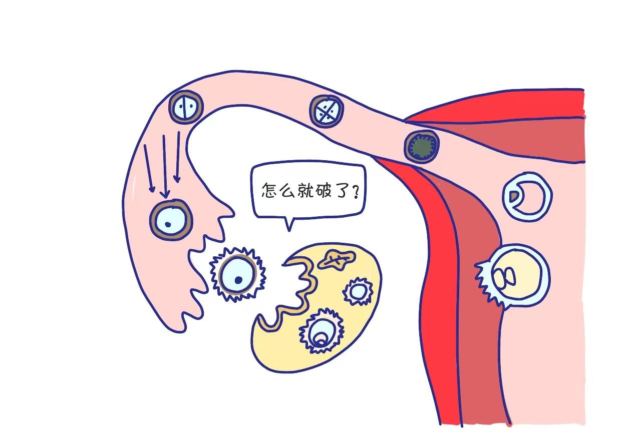 怎么用力过猛会导致黄体破裂,受外力撞击导致黄体破裂