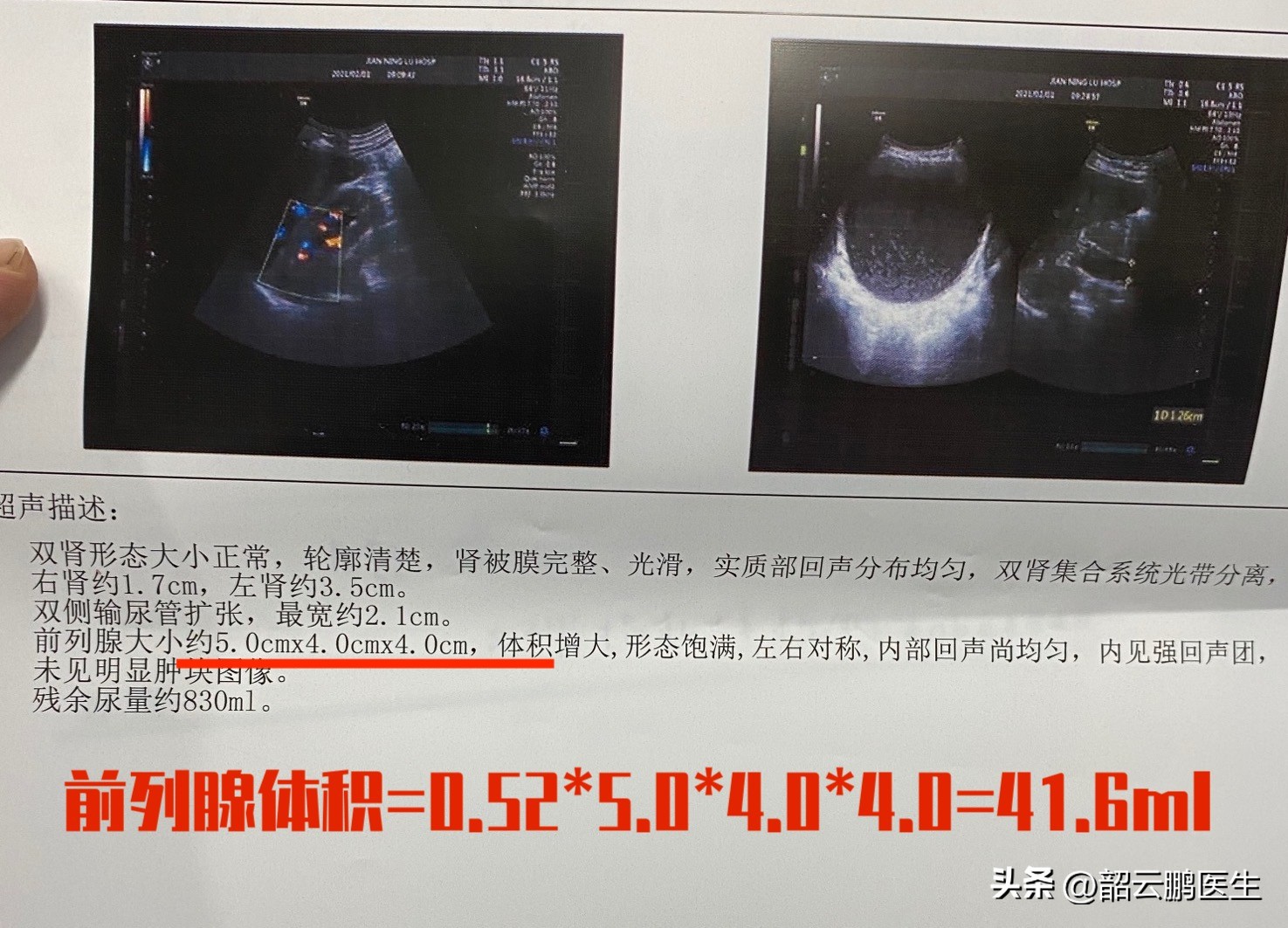psa诊断早期前列腺癌的准确率,筛查前列腺psa需要空腹吗