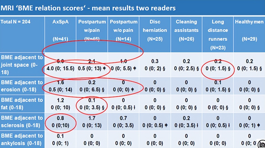 骶髂关节骨髓水肿最好的治疗方案,骶髂关节炎是脊柱关节病的一种吗