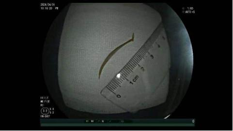 腹痛难忍竟是鱼刺作祟小肠镜巧取异物成功排险