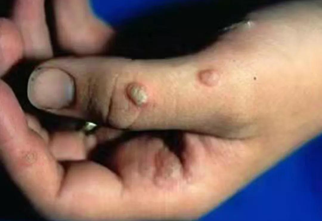 耳朵边有颗大痣这个位置会病变吗,什么样的痣容易癌变不能点