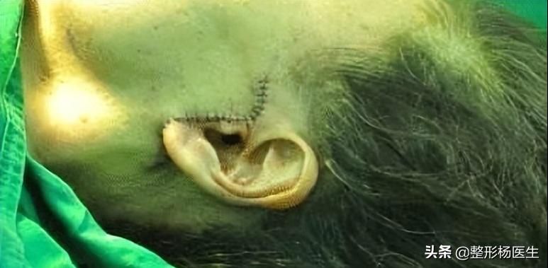 拉皮手术后遗症怎么治,拉皮手术好不好