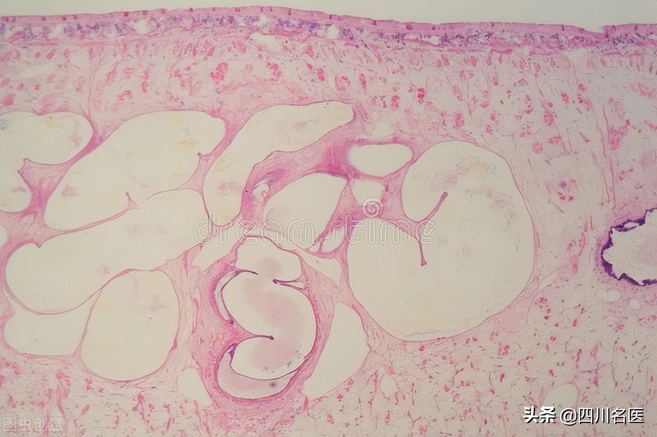 四川女子大脑吃出虫子,四川最易感染的寄生虫