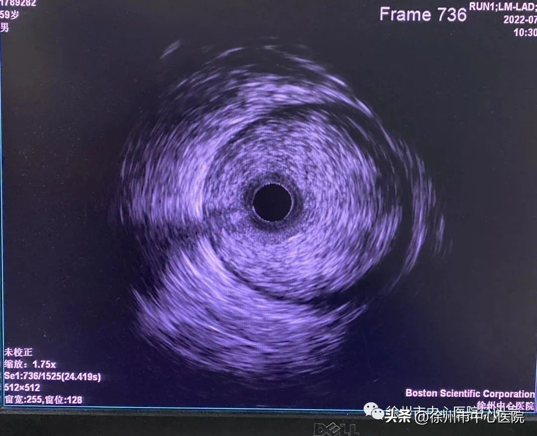 冠状动脉血管内超声属于几级手术,冠状动脉血管介入治疗