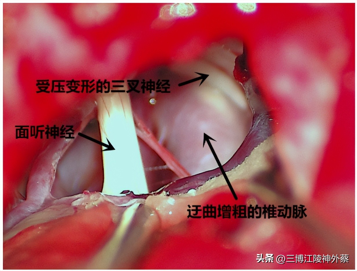 双侧面肌痉挛真实案例,面肌痉挛会发展成三叉神经痛吗