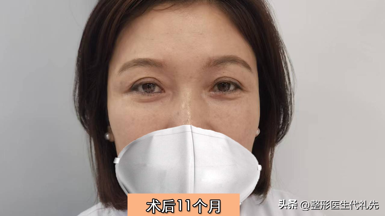 眼窝凹陷怎么填充不会肿眼泡,眼窝脂肪填充鼓包补救方法是什么