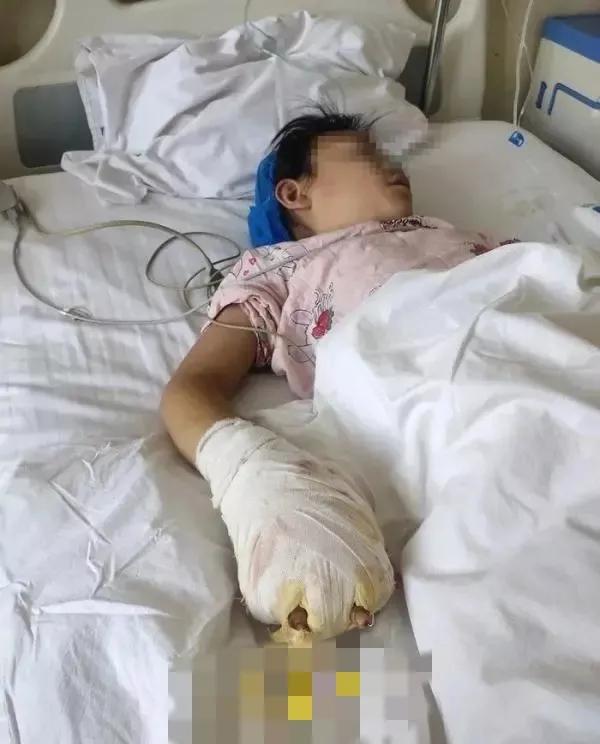 后妈狠心用烟头弄孩子手上痛哭,后妈疑把女童双手按进热水锅致残