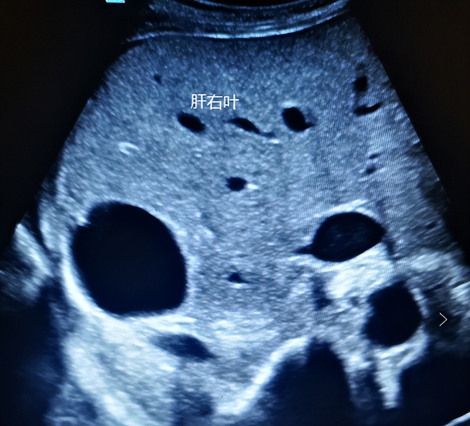 超声介入入门,手把手教你入门超声