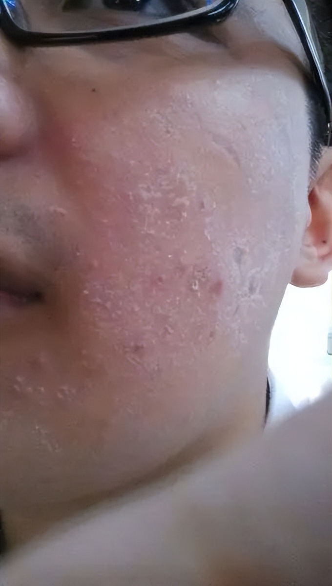 男生脸上很多处脱皮怎么办,男生脸上脱皮干燥