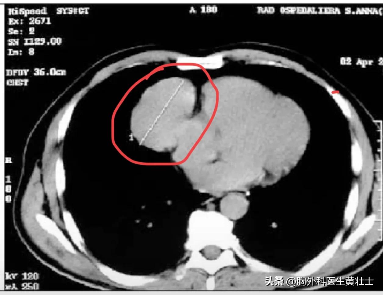 异位胸腺需要注意什么,异位胸腺看什么科