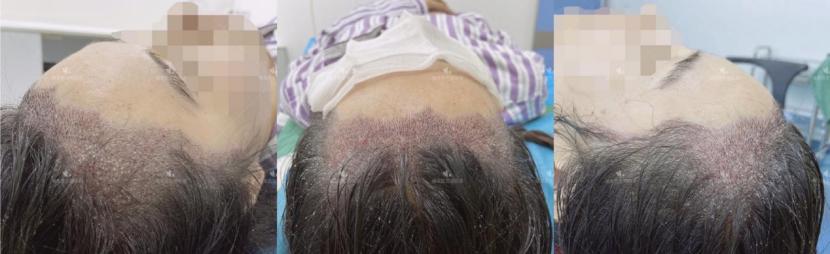 植发手术后恢复全过程,植发手术全过程详解