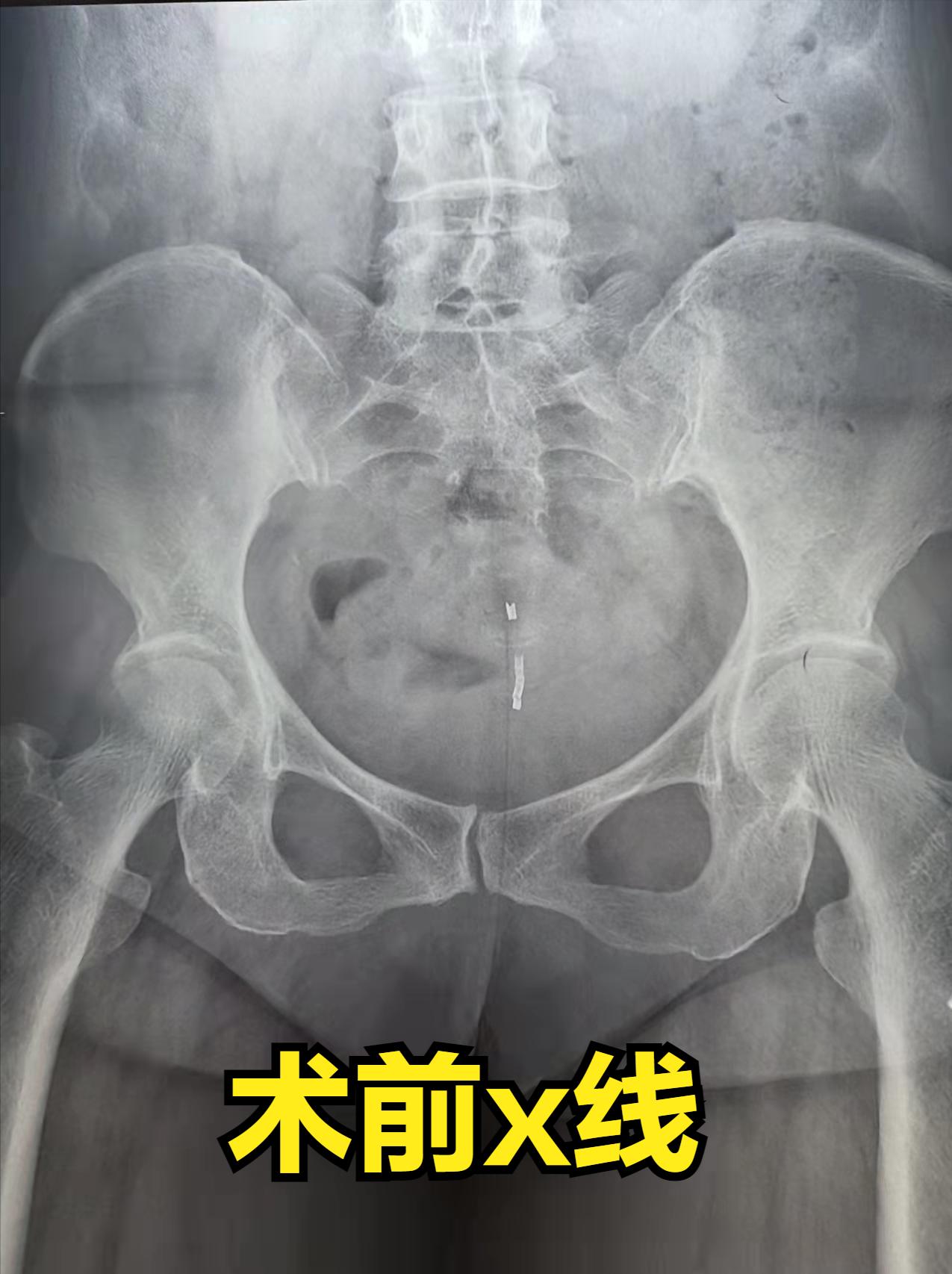 有没有最快的取环方法,取环大多数要几分钟啊