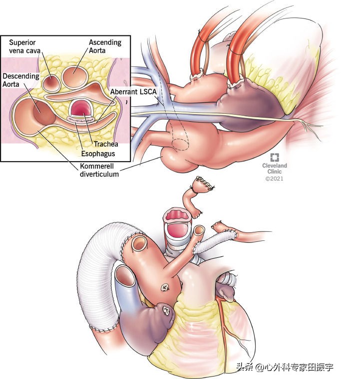 Kommerell憩室和迷走型锁骨下动脉修复术