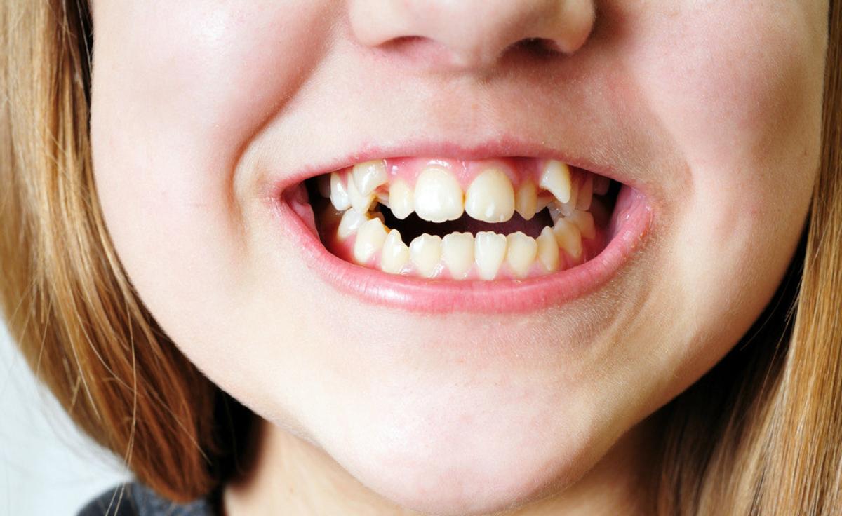 丹美大真探|孩子得龋齿怎么办？