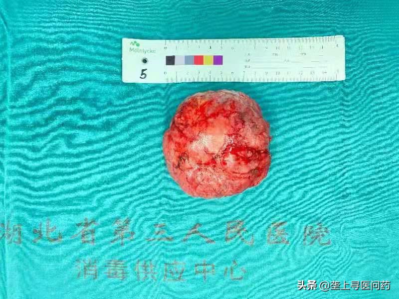 年轻女生胸部有肿瘤是啥原因,52岁女士胸部长个小瘤子越来越大