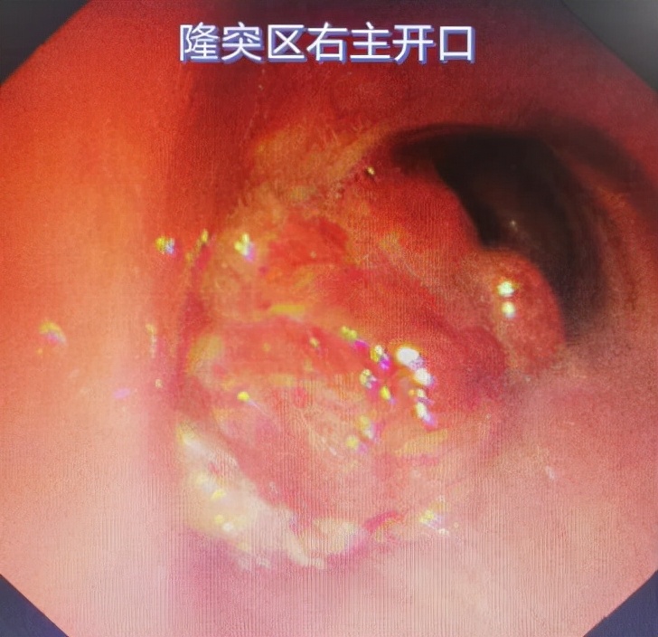 哈医大一院气管镜,哈医大群力呼吸内科