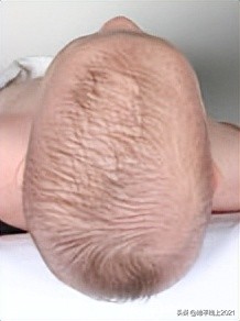 想让孩子有一个漂亮的头型，如何预防和治疗偏头与扁头？