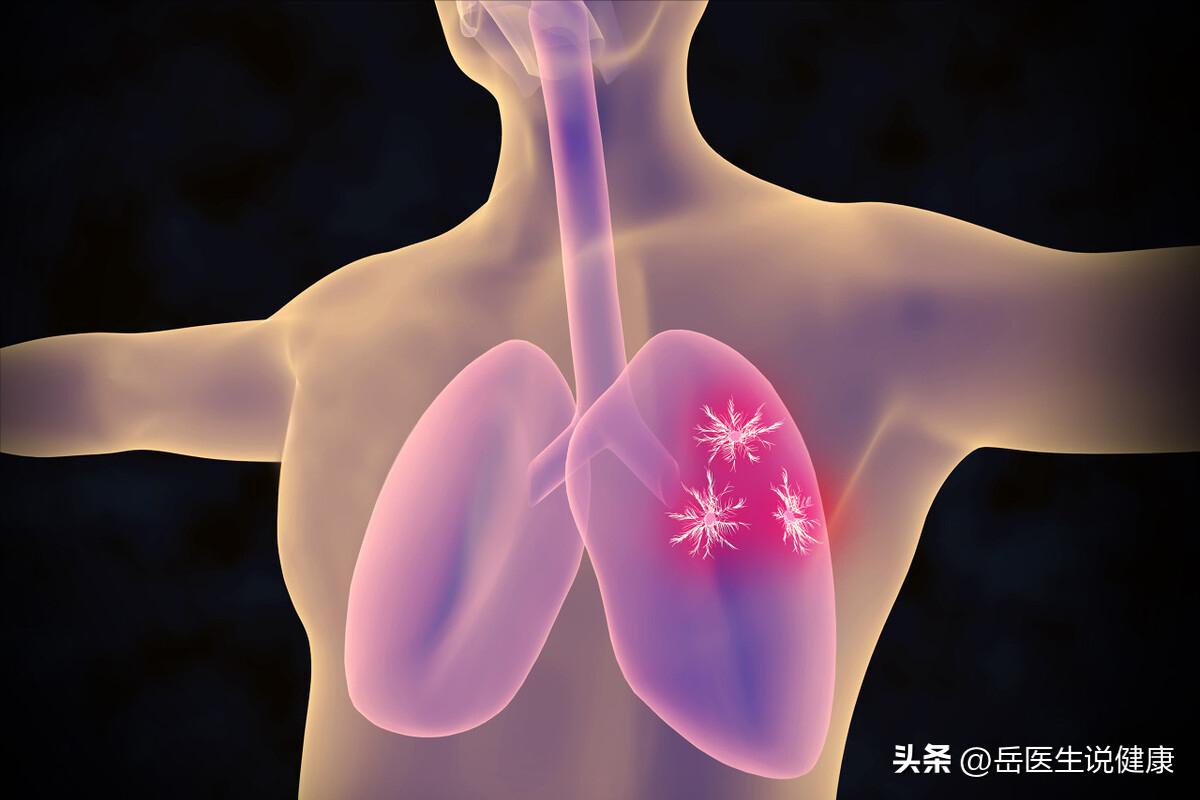 肺癌引起肩疼和一般肩疼区别,肩痛可能是肺癌早期