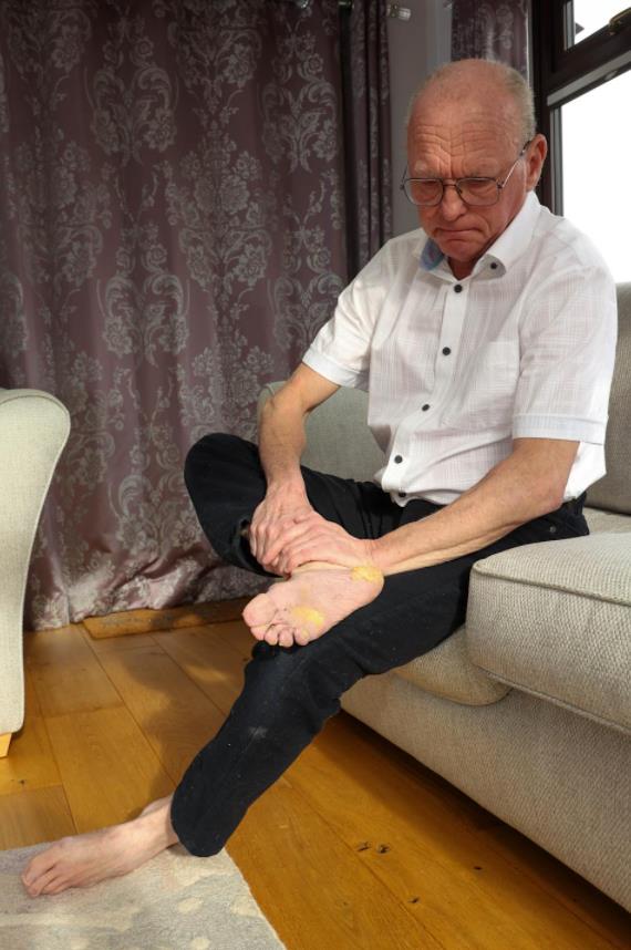 英国男子患罕见怪病,英国61岁癌症老头