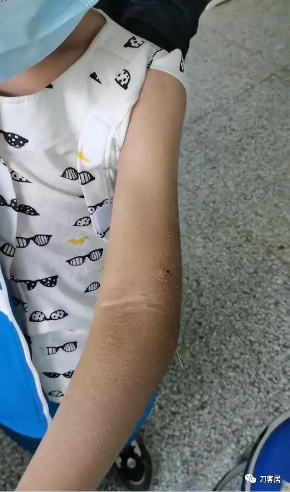 孩子胳膊摔伤肿了不能弯曲一直疼,9岁男孩摔倒手臂痛怎么办