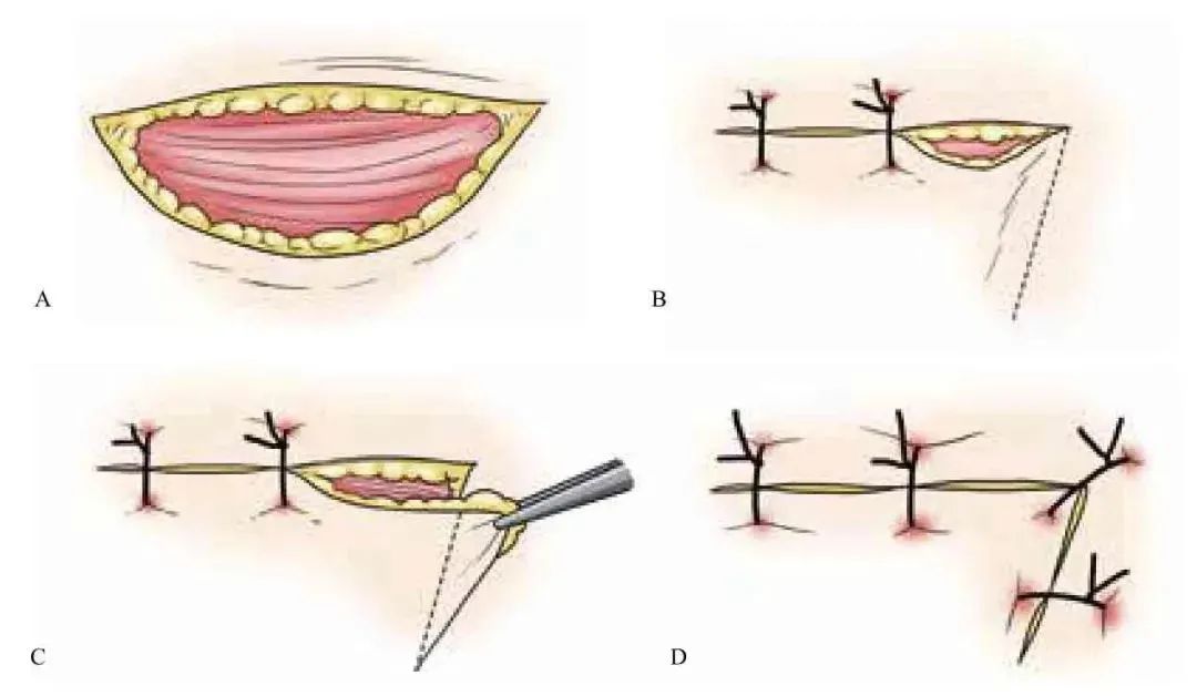 3分钟get:真正的外科缝合秘籍
