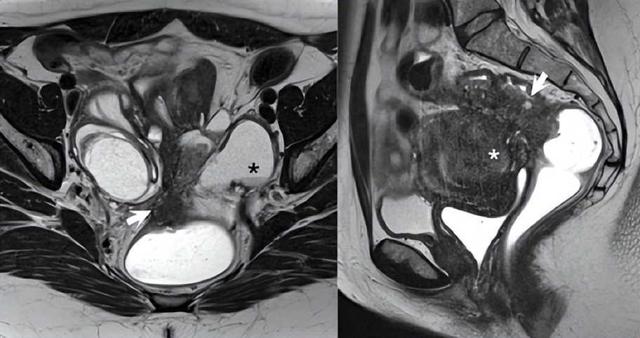卵巢病变需要做什么检查,卵巢巧克力囊肿磁共振表现