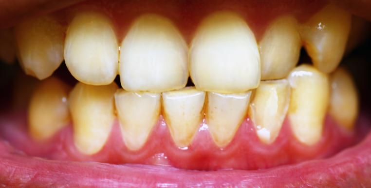 孕妈妈牙龈肿了个肉坨出血怎么办,孕妈妈牙龈