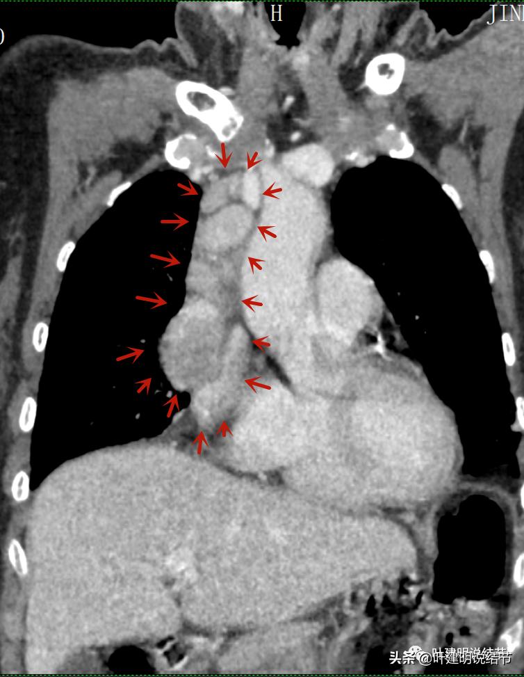 这位老乡，乏力来查，查出这么大个的纵隔肿瘤！会是什么呢？