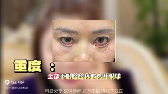 手术后下眼睑外翻怎么自然恢复,外切眼袋后下眼睑外翻多少算正常