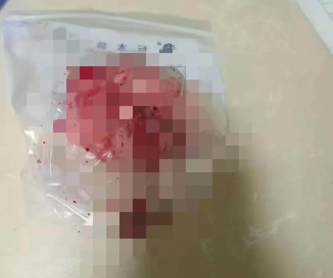 子宫肌瘤消融手术费用价格表,子宫肌瘤手术费用大约多少钱