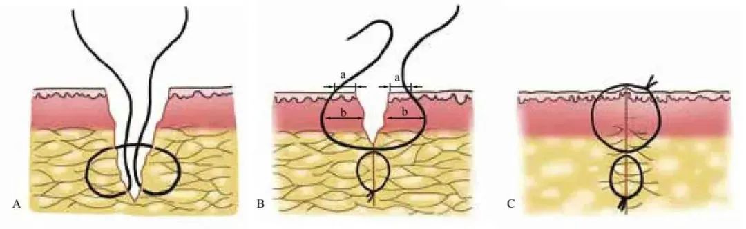 3分钟get:真正的外科缝合秘籍