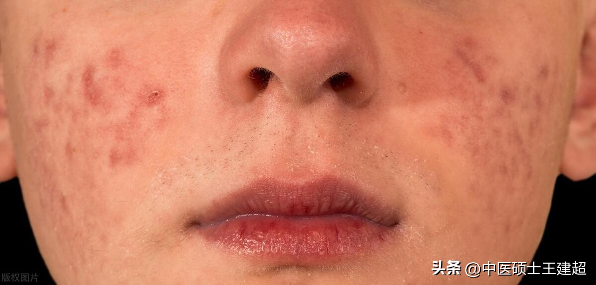 长口腔溃疡和脸上长痘痘吃什么好,口腔溃疡长痘是虚火还是实火