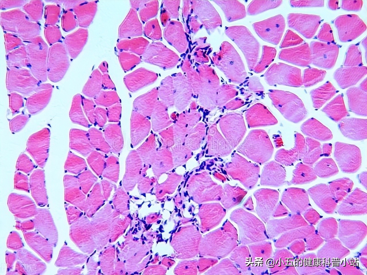 活血化瘀冠心病,冠心病人能吃心脑宁胶囊吗